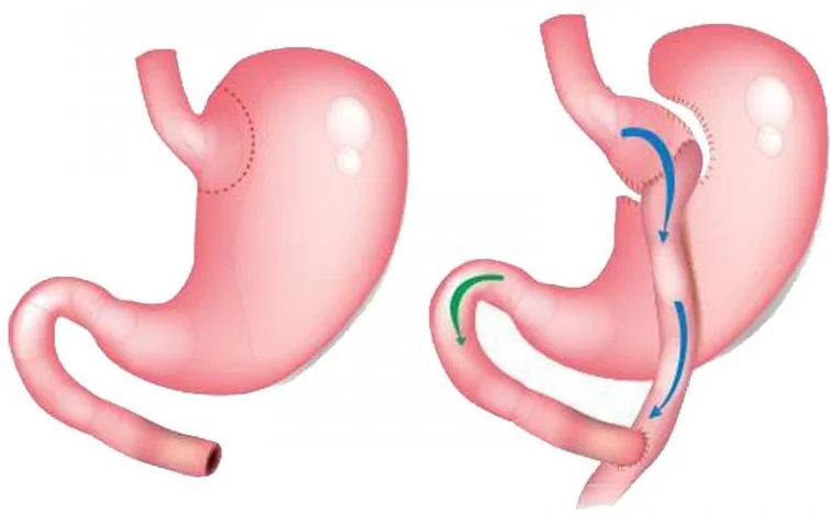 تحويل مسار المعدة الكلاسيكي
