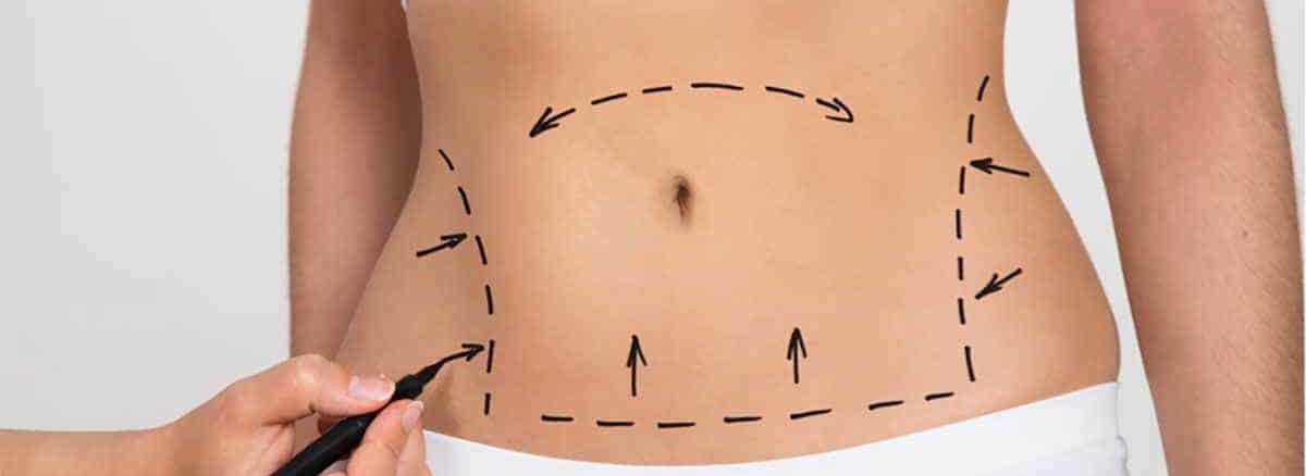 ما هو تكميم البكيني