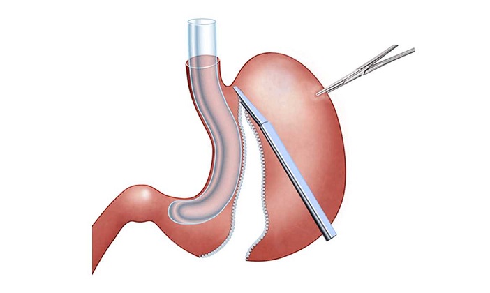 ما هو تكميم المعدة بالمنظار