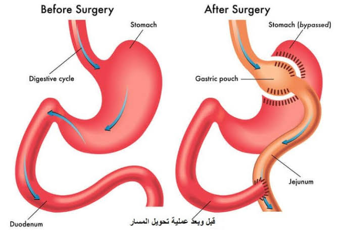 هل يرجع الوزن بعد تحويل المسار